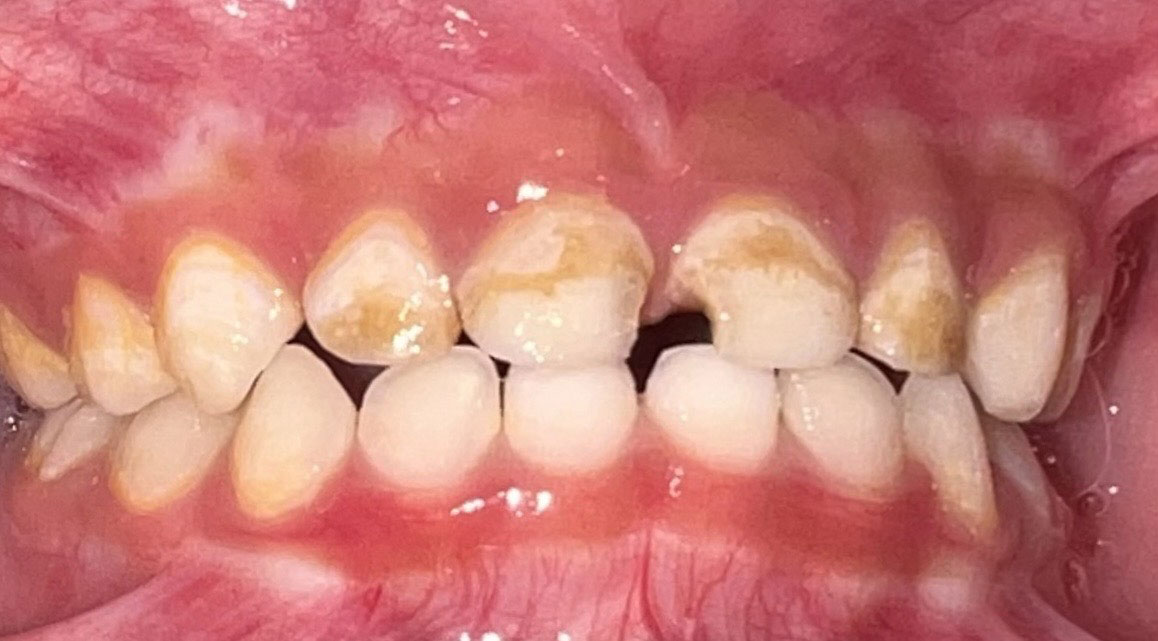 Our Battle with Early Childhood Caries | Pediatric Dentistry Center Philippines Our Battle with Early Childhood Caries | Pediatric Dentistry Center Philippines